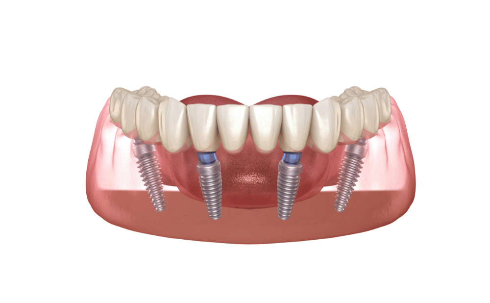 オールオンフォーが向いている人