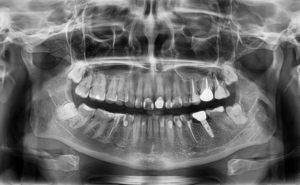 骨が少ないとインプラントが難しい理由