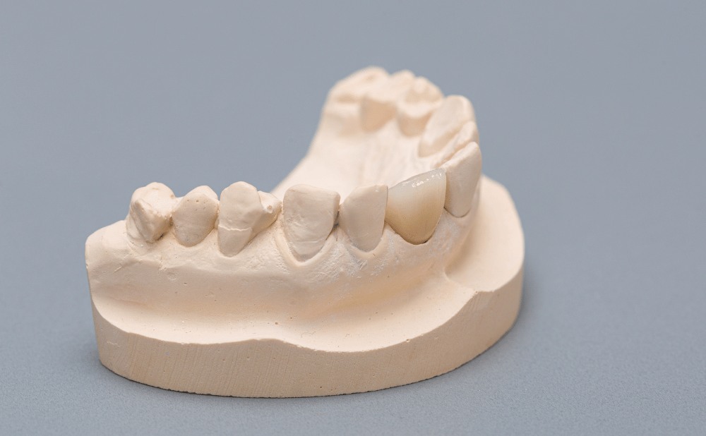 抜歯矯正とほほこけ