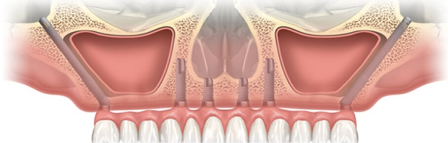 Zygoma implant 骨の量が少ない場合の特殊手術ザイゴマインプラント